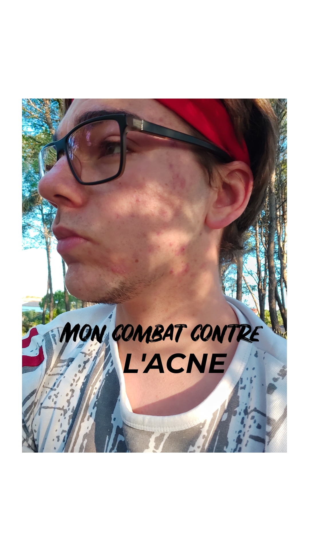 Mon combat contre&nbsp;l&rsquo;acné